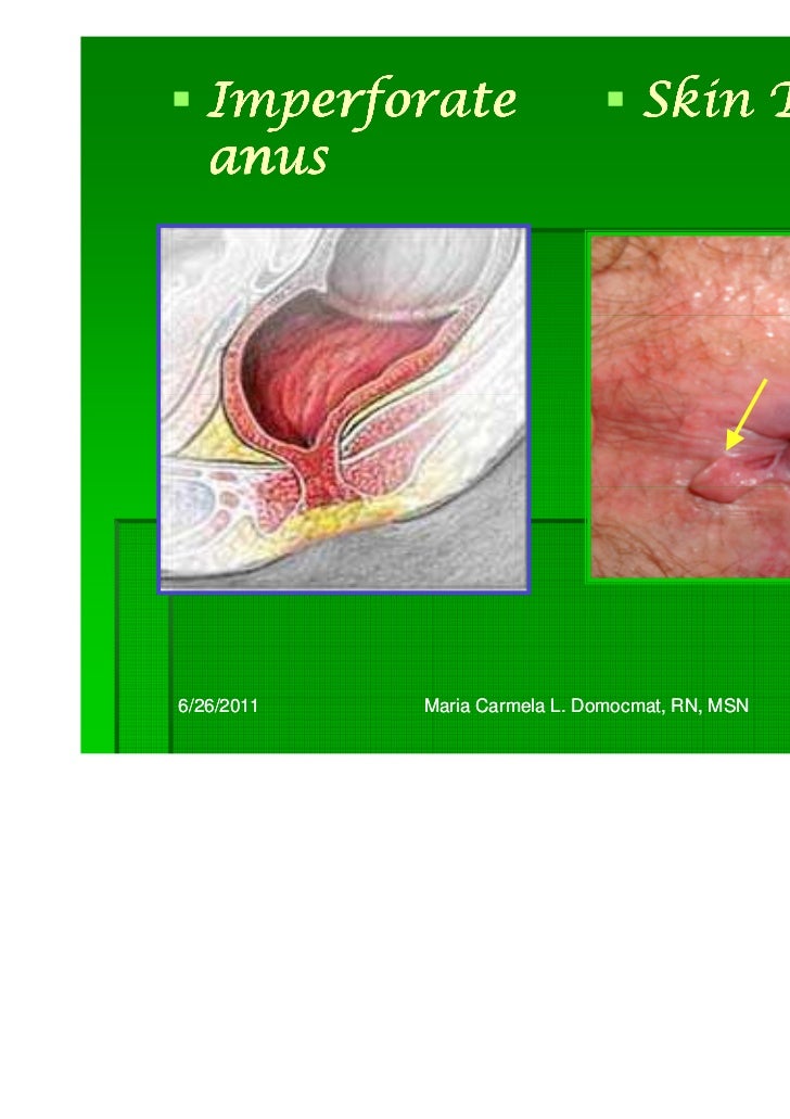 Man gets handjob while driving Normal skin tag anus inch